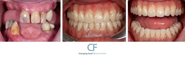 Cheap 
      Dentures Fullerton CA 92838